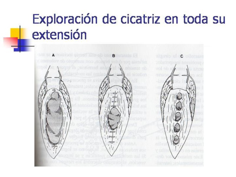 Diapositiva 7 de Hernia Incisional