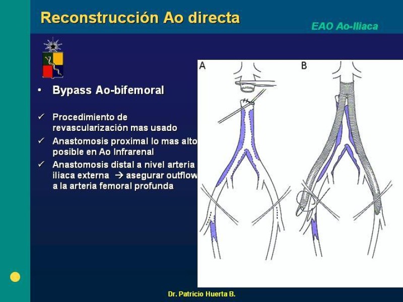 Diapositiva 9 de Tratamiento Quirúrgico de la EAO Aorto- Iliaca