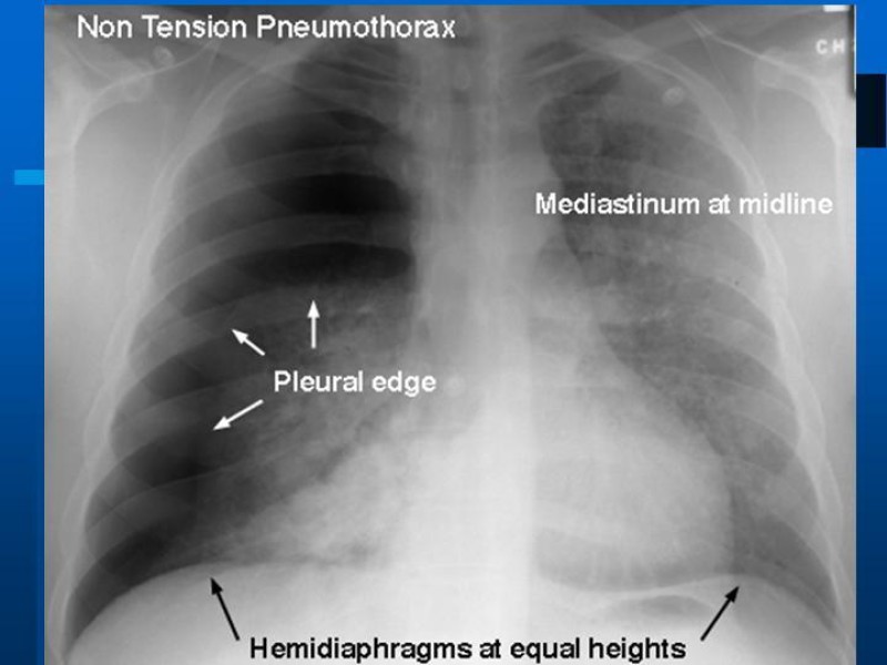 Diapositiva 1 de Neumotórax Espontáneo Primario