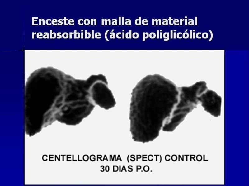 Diapositiva 29 de Trauma Esplenico