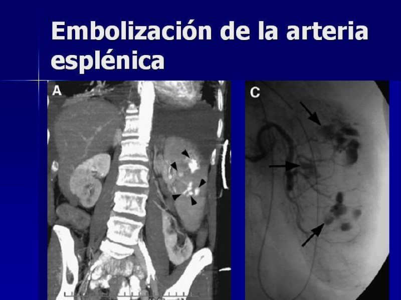 Diapositiva 36 de Trauma Esplenico