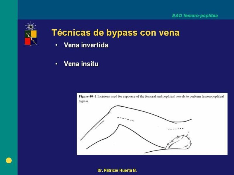 Diapositiva 15 de Tratamiento Quirúrgico de la EAO Fémoro-Poplítea