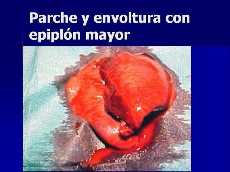 Diapositiva 32 de Trauma Esplenico