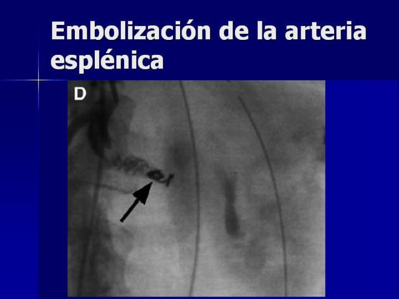 Diapositiva 37 de Trauma Esplenico