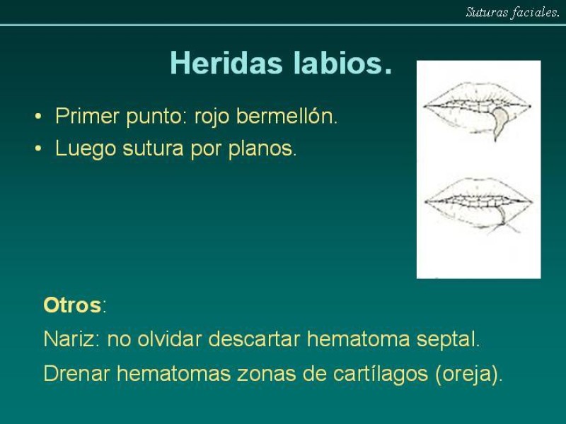 Diapositiva 11 de Suturas Faciales