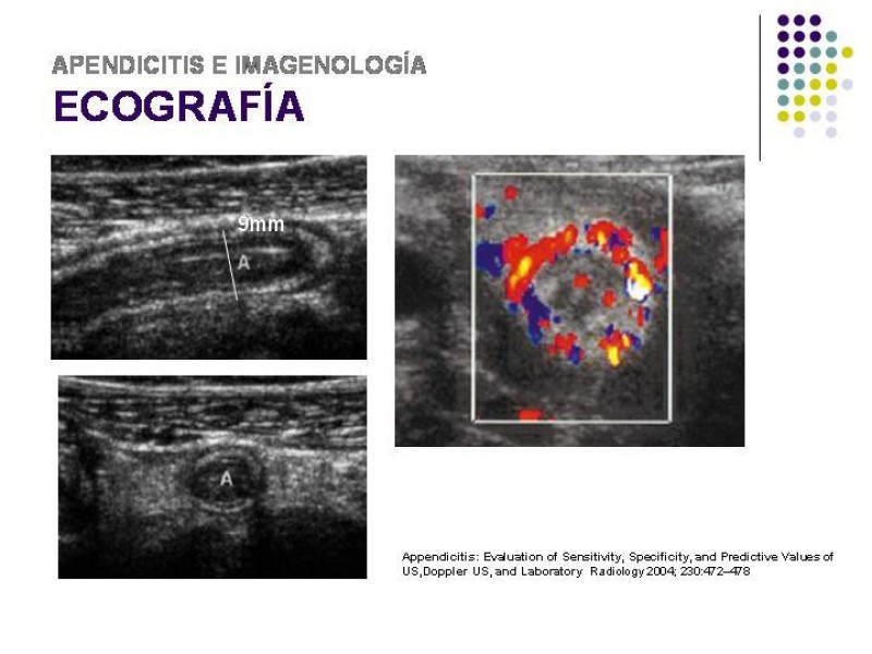 Diapositiva 22 de Imagenología y Apendicitis