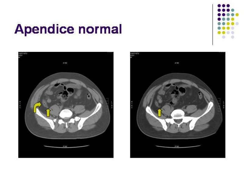 Diapositiva 31 de Imagenología y Apendicitis