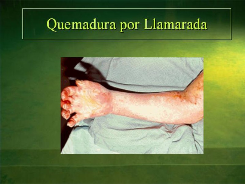 Diapositiva 29 de Lesiones Eléctricas