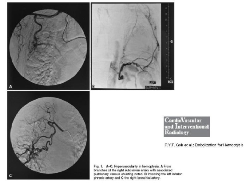Diapositiva 15 de Hemoptisis Masiva