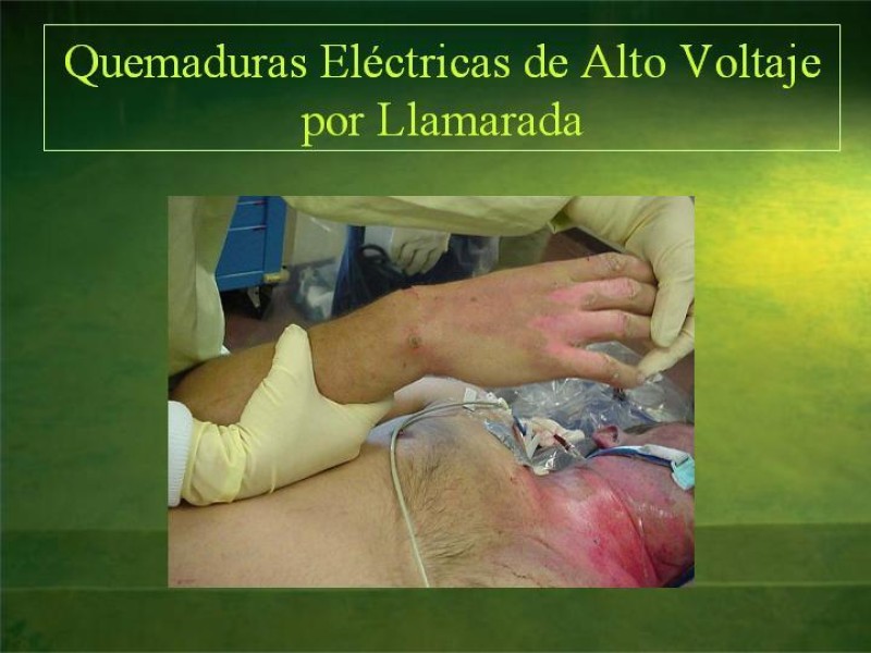 Diapositiva 23 de Lesiones Eléctricas