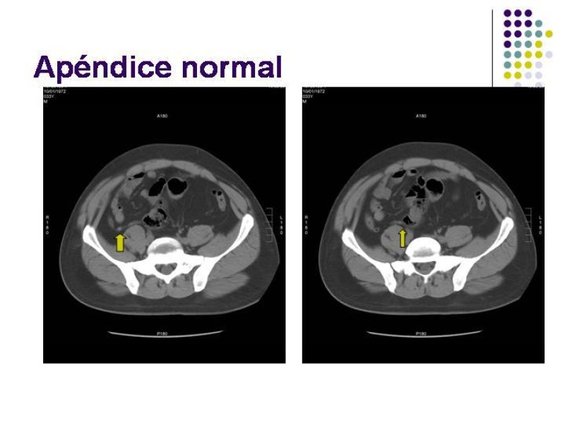 Diapositiva 32 de Imagenología y Apendicitis