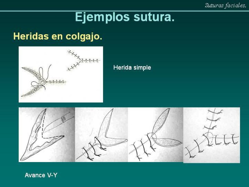 Diapositiva 9 de Suturas Faciales