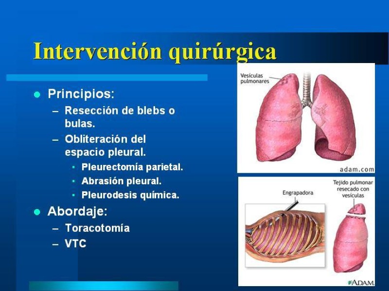 Diapositiva 20 de Neumotórax Espontáneo Primario