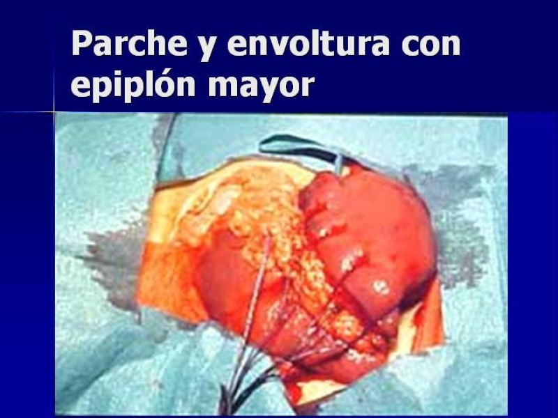Diapositiva 34 de Trauma Esplenico