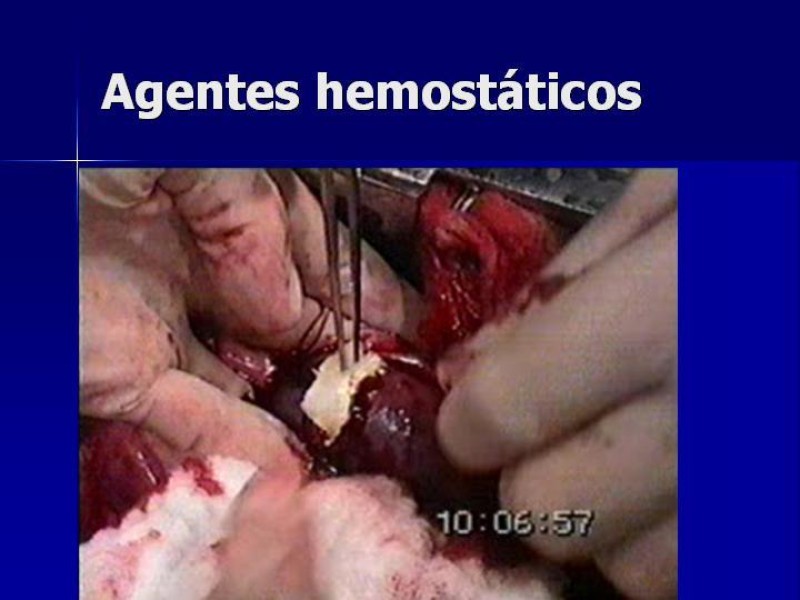 Diapositiva 17 de Trauma Esplenico