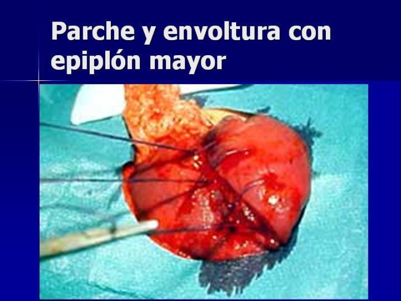 Diapositiva 33 de Trauma Esplenico