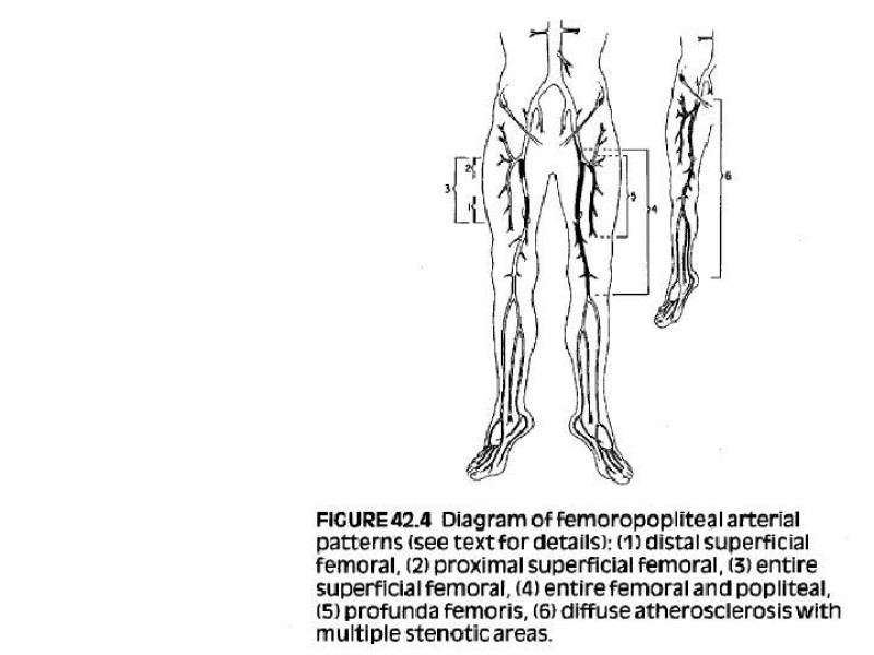 Diapositiva 3 de Tratamiento Quirúrgico de la EAO Fémoro-Poplítea