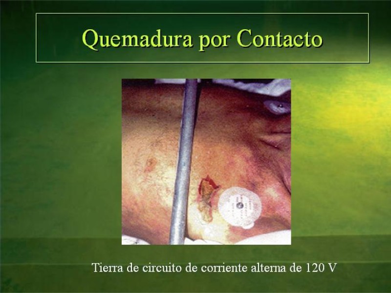Diapositiva 30 de Lesiones Eléctricas