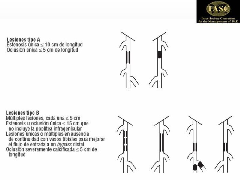Diapositiva 4 de Tratamiento Quirúrgico de la EAO Fémoro-Poplítea