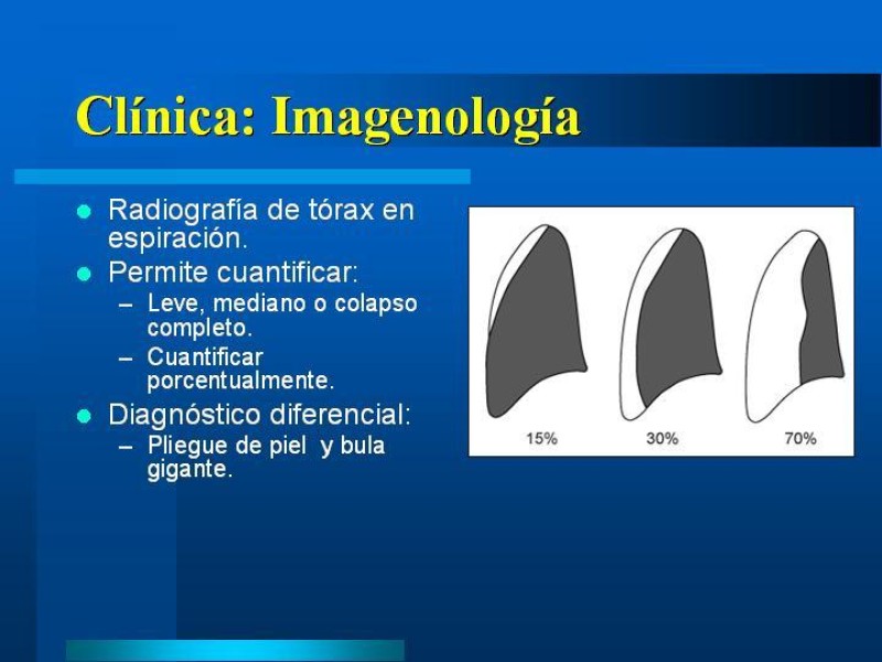Diapositiva 9 de Neumotórax Espontáneo Primario
