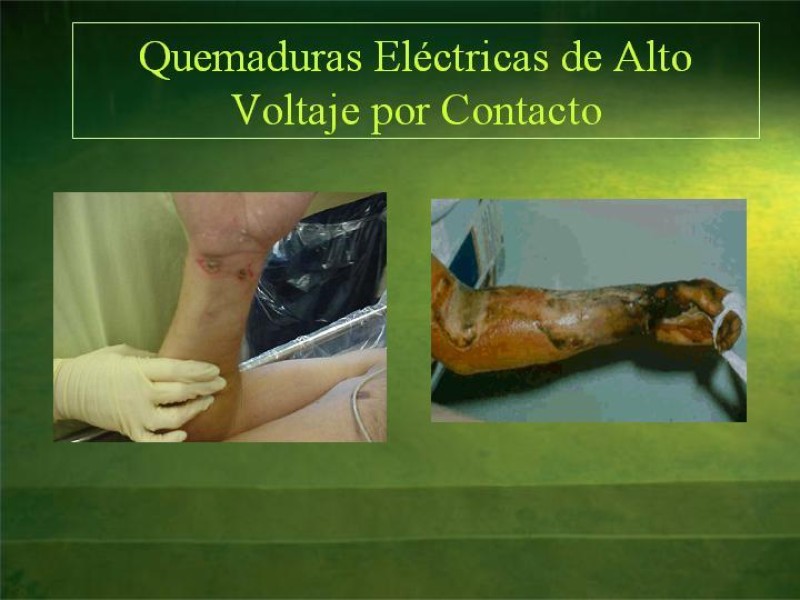 Diapositiva 22 de Lesiones Eléctricas