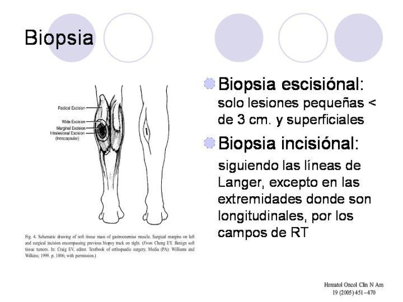Diapositiva 16 de Sarcomas