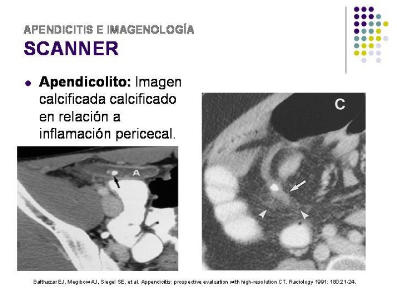 Diapositiva 34 de Imagenología y Apendicitis