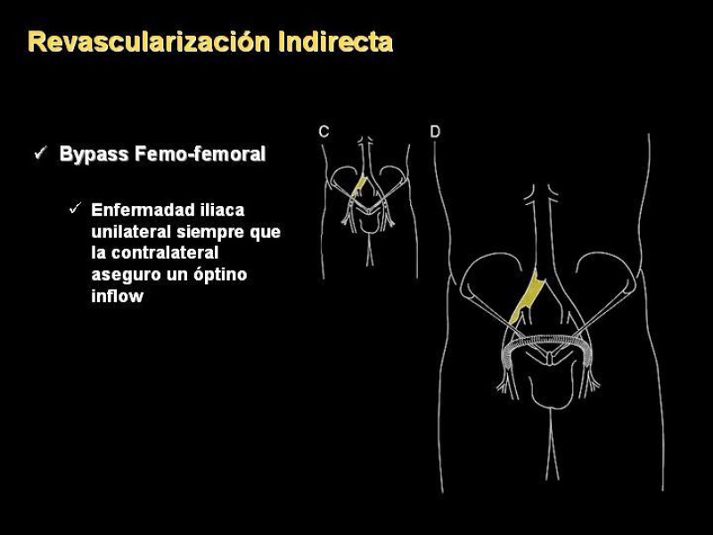 Diapositiva 15 de Tratamiento Quirúrgico de la EAO Aorto- Iliaca