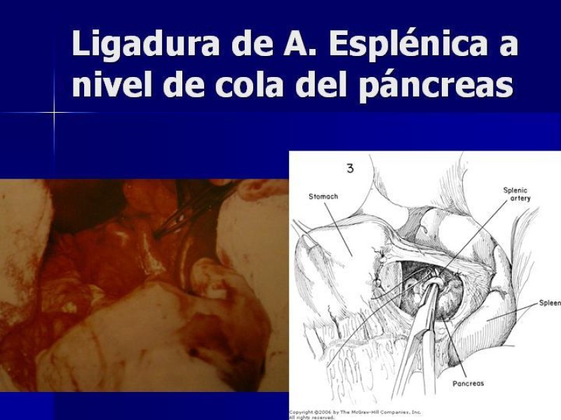 Diapositiva 22 de Trauma Esplenico
