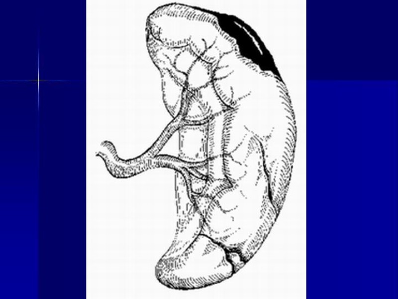 Diapositiva 4 de Trauma Esplenico