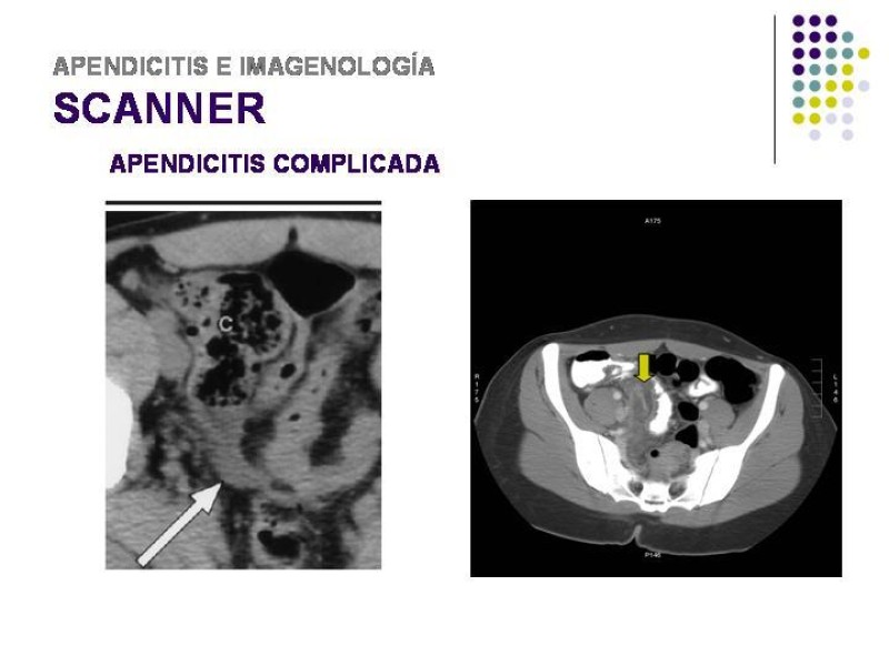 Diapositiva 36 de Imagenología y Apendicitis
