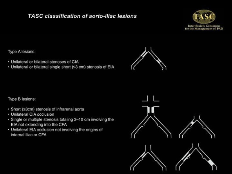 Diapositiva 3 de Tratamiento Quirúrgico de la EAO Aorto- Iliaca