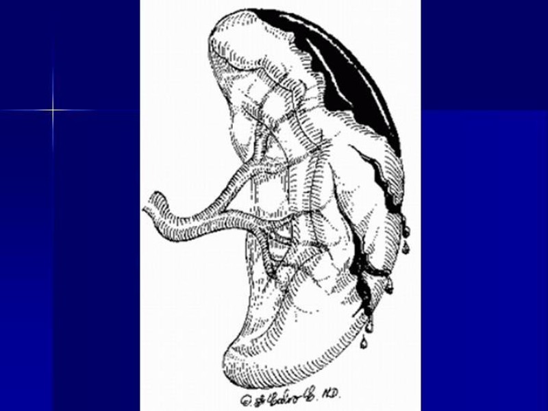 Diapositiva 6 de Trauma Esplenico