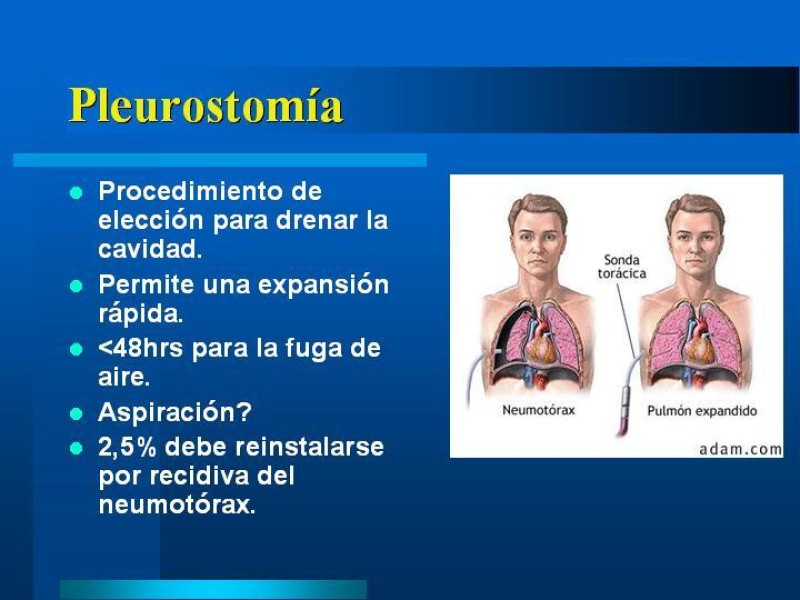Diapositiva 18 de Neumotórax Espontáneo Primario