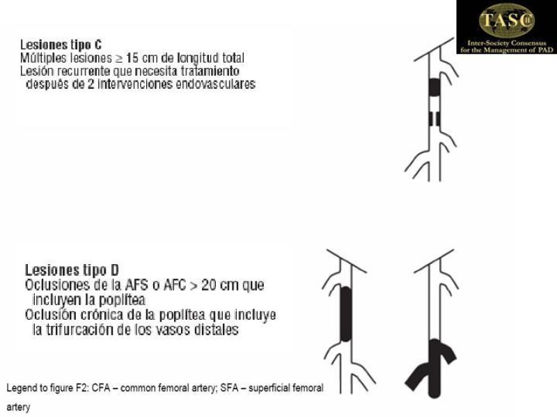 Diapositiva 5 de Tratamiento Quirúrgico de la EAO Fémoro-Poplítea
