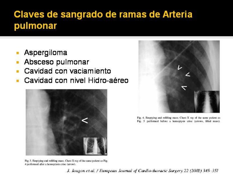 Diapositiva 10 de Hemoptisis Masiva
