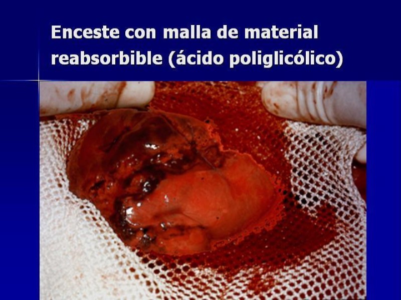 Diapositiva 27 de Trauma Esplenico
