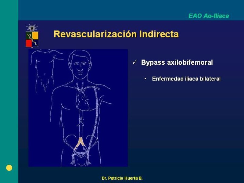 Diapositiva 14 de Tratamiento Quirúrgico de la EAO Aorto- Iliaca