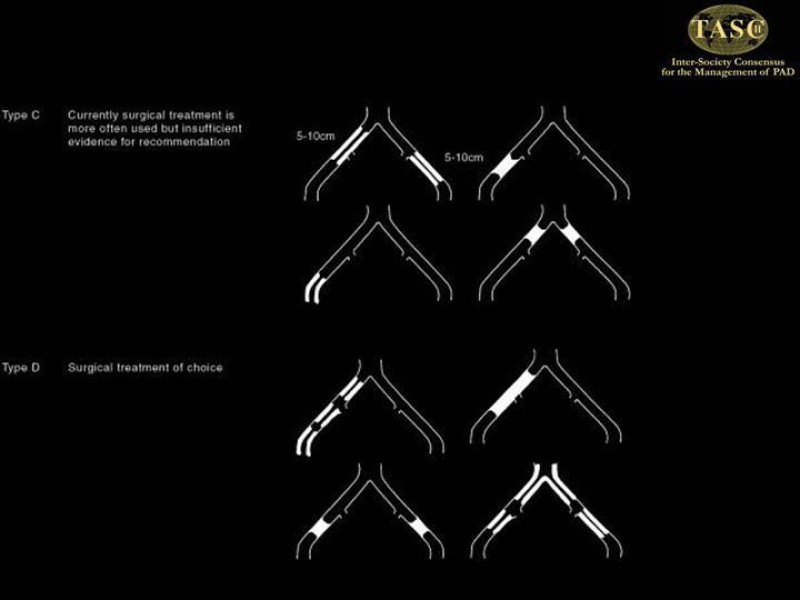 Diapositiva 6 de Tratamiento Quirúrgico de la EAO Aorto- Iliaca