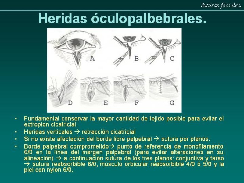 Diapositiva 10 de Suturas Faciales