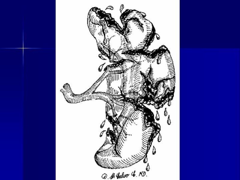 Diapositiva 12 de Trauma Esplenico
