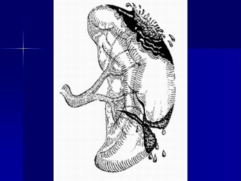 Diapositiva 8 de Trauma Esplenico