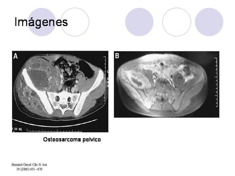 Diapositiva 18 de Sarcomas