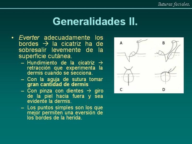 Diapositiva 4 de Suturas Faciales