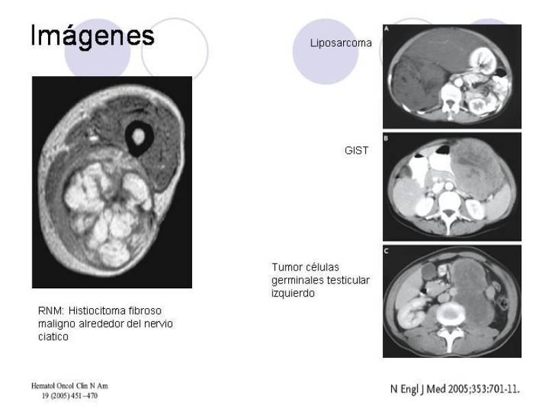 Diapositiva 19 de Sarcomas