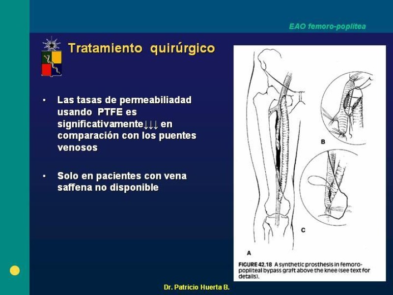 Diapositiva 13 de Tratamiento Quirúrgico de la EAO Fémoro-Poplítea