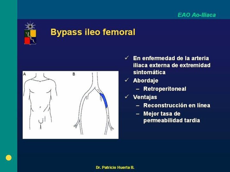 Diapositiva 12 de Tratamiento Quirúrgico de la EAO Aorto- Iliaca