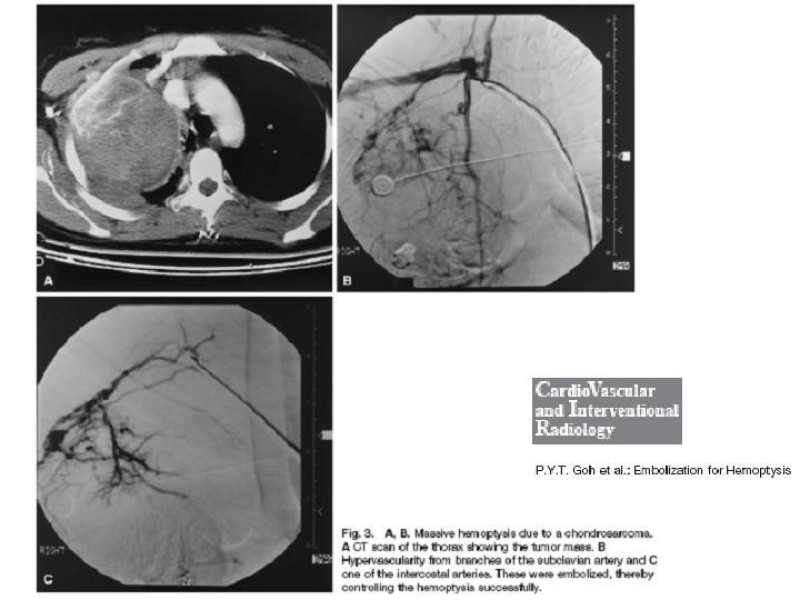 Diapositiva 16 de Hemoptisis Masiva