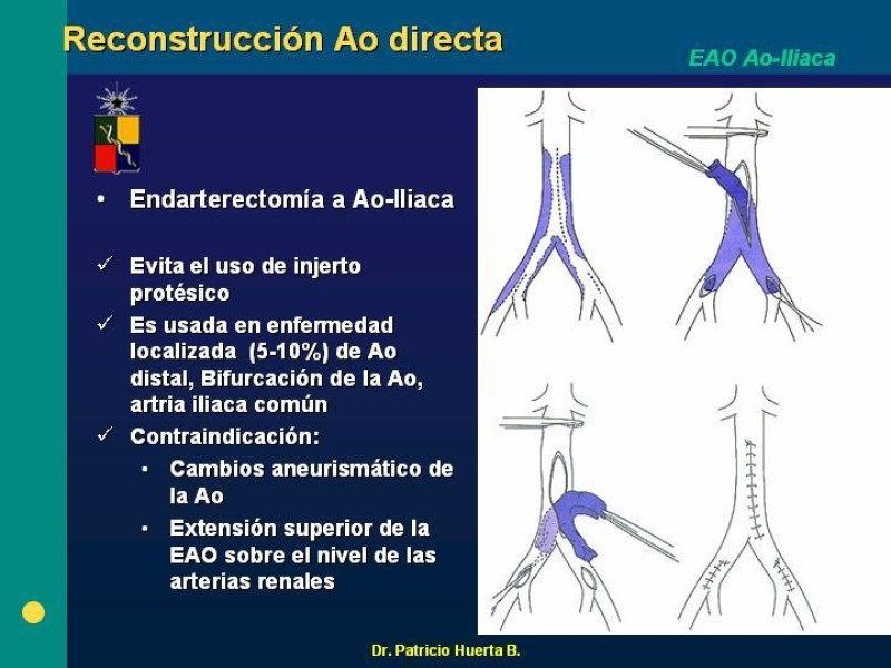 Diapositiva 7 de Tratamiento Quirúrgico de la EAO Aorto- Iliaca