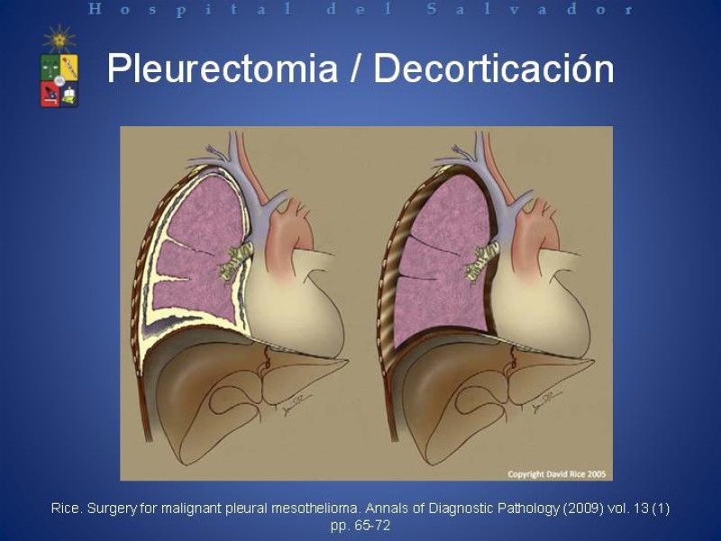 Diapositiva 21 de Mesotelioma Pleural